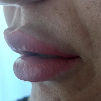 Hatalı Estetik İşlemleri Ve Doktorun Suçlayıcı Tutumu