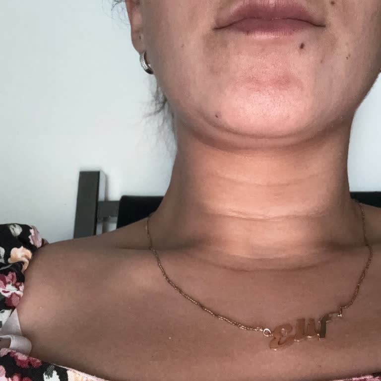 Yanıltıcı Dolgu Uygulaması Ve Ücret İadesi İsteği