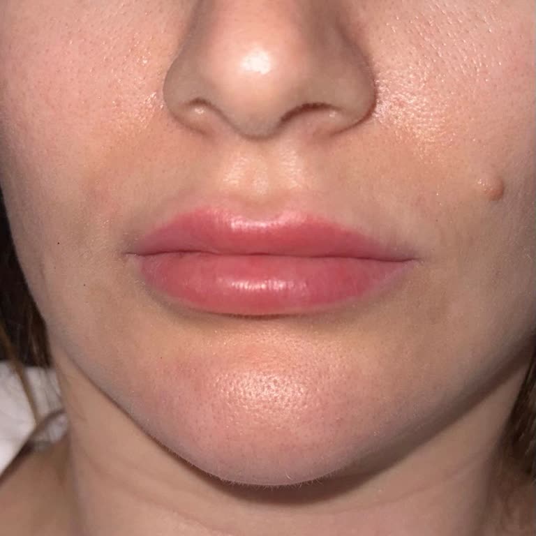 Russian Lips Quenn (russianlips.queen) Altı Bin TL'lik Ücretine Karşılık Gelmeyen Dudak Dolgusu