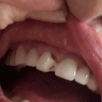 Diş Dökülmesi Sonrası Sorumluluk Reddi, Klinik Ücretsiz Yeniden Tedavisi