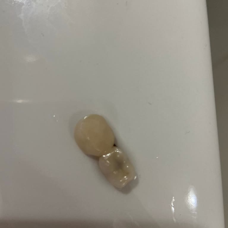 Kartal Diş Adresim Kliniğinde Kaplama Dişi Sürekli Çıkıyor Ve Ücret Talep Ediliyor