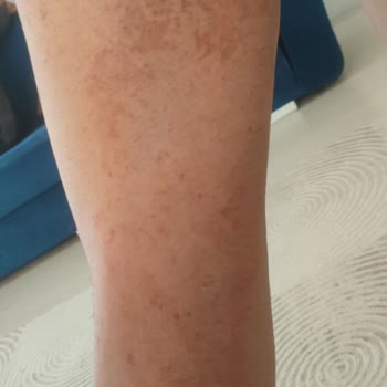 Agiss Tüy Dökücü Kreminin Yanıkları Ve Kalıcı İz Tehdidi
