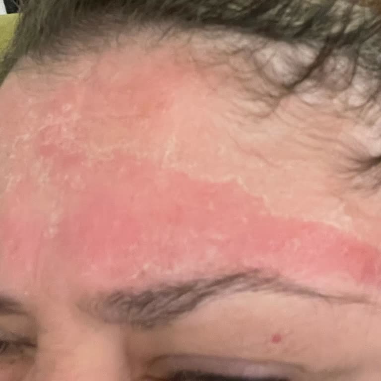 Bioderma Güneş Kremi Cilt Yanığı Yaptı, Yardımcı Olmadı
