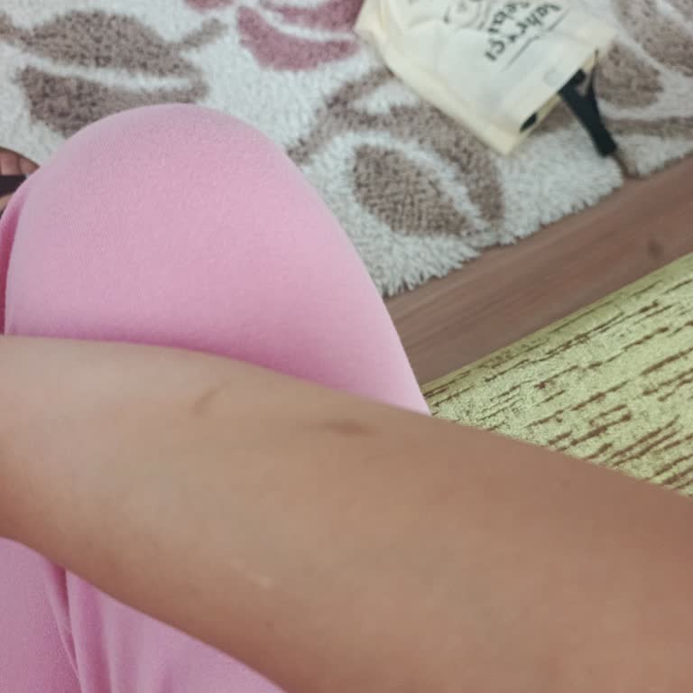 Saç Maşası Patlaması Ve Yanığı: Sağlık Riskine Karşı Yetersiz İade Çözümü