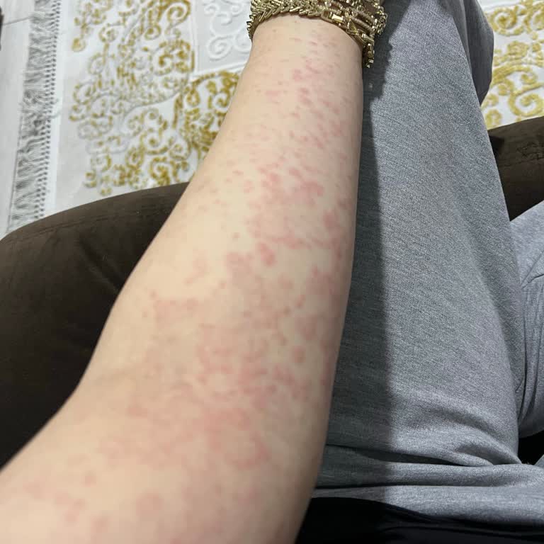 Palmolive Orange Shower Gel Triggers Severe Allergic Reaction and Body Rash