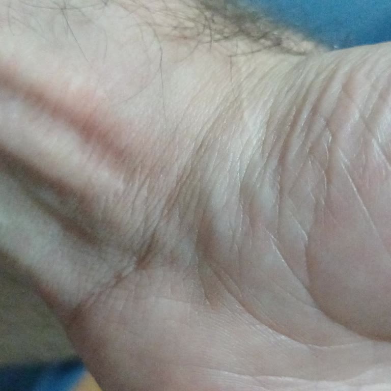 Huawei Watch GT 6 Üzerindeki Kaşıntı Ve Haksız İade Reddi