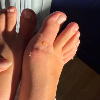 Mango Sandaleti İlk Kullanımda Ayağımda Yaralar Oluşturdu, Mağaza Yardım Reddetti