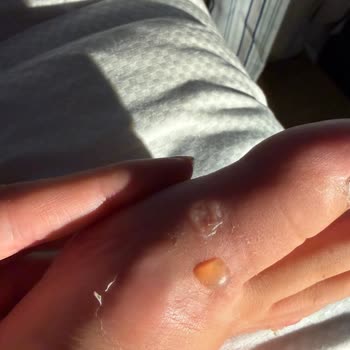 Mango Sandaleti İlk Kullanımda Ayağımda Yaralar Oluşturdu, Mağaza Yardım Reddetti