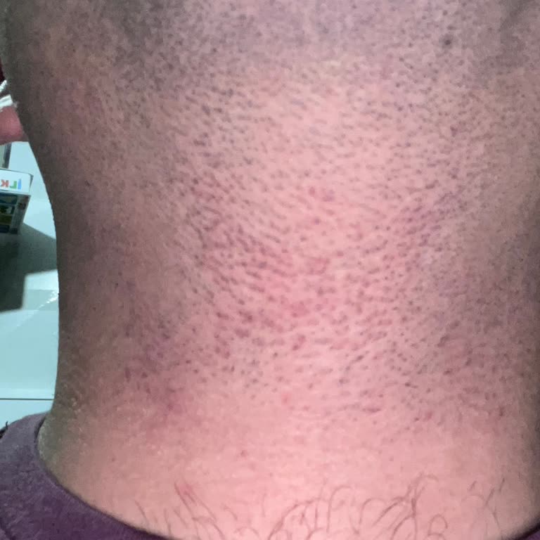 Gillette Proglide Bıçağı Cildimde Kesik Ve Şiddetli Tahriş Yarattı