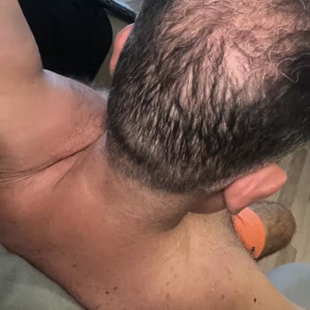 Orta Bölgedeki Saç Ekimi Sonuçları Tutmadı Ve Ücretsiz Düzeltme Talep Ediyorum