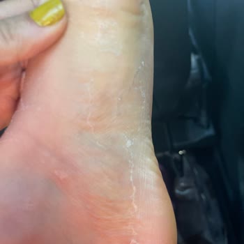 Dermokil Ayak Maskesi Sonrası Şiddetli Deri Soyulması Ve Uzun Süreli Rahatsızlık