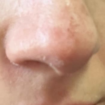 Mi Piel Se Vuelve Sensitiva y Roja Tras Usar el Peeling Pad de Missha