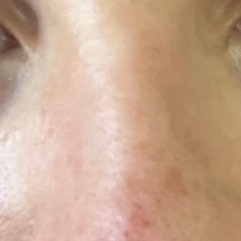 Mi Piel Se Vuelve Sensitiva y Roja Tras Usar el Peeling Pad de Missha
