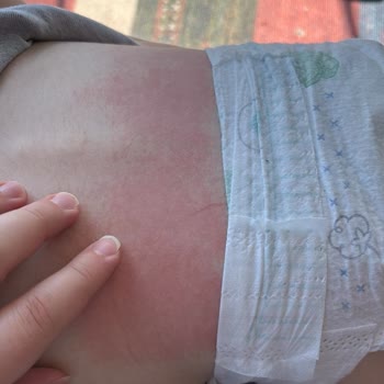 Aktif Bebek 6 Numaralı Bezlerde Alerjik Reaksiyon Ve Geri Çekilme Talebi