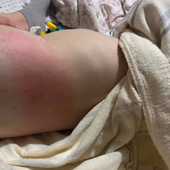 Aktif Bebek 6 Numaralı Bezlerde Alerjik Reaksiyon Ve Geri Çekilme Talebi