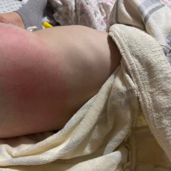 Aktif Bebek 6 Numaralı Bezlerde Alerjik Reaksiyon Ve Geri Çekilme Talebi