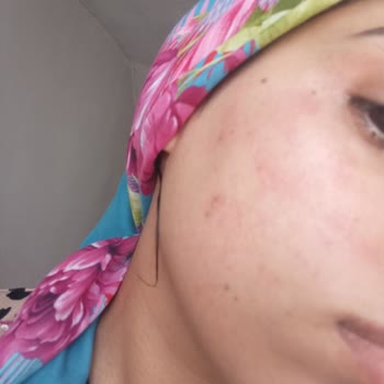 Vi-Vet Tüy Sarartıcı Krem Kullanımında Şiddetli Yanma Ve Yanık İzleri