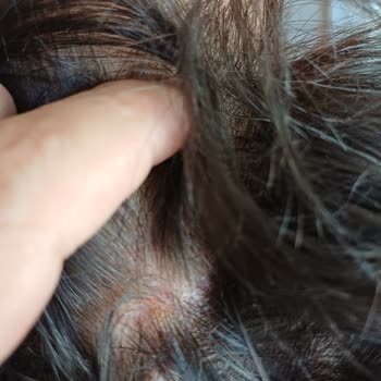 Yeni Şampuan Seboreik Dermatit Tetikledi, Eski Mor Şampuanın Üretimi Talep Ediliyor