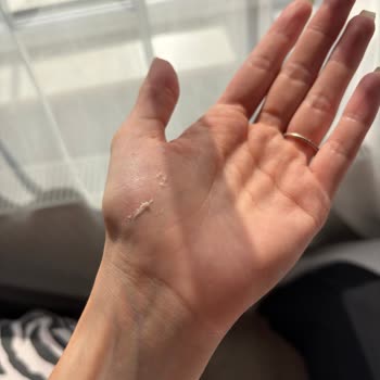 Cherylift Çift Taraflı Yapışkanlı Ped Kıyafeti Mahvetti, Cilde Zarar Verdi, İade Talebi