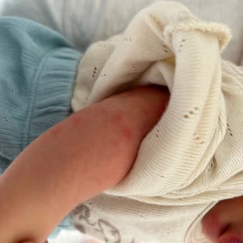 Güvenli Olduğu İddia Edilen Bebek Yağında Alerjik Reaksiyon