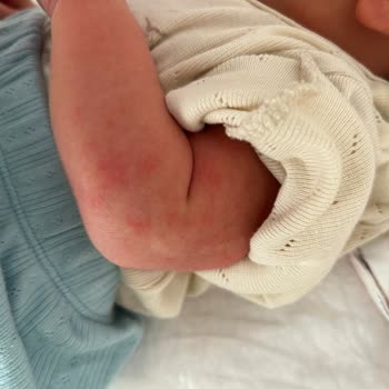 Güvenli Olduğu İddia Edilen Bebek Yağında Alerjik Reaksiyon
