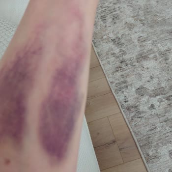 Kan Alımında Dikkatsiz Ve Kaba Personel Davranışı Nedeniyle Şiddetli Ağrı Ve Morluk