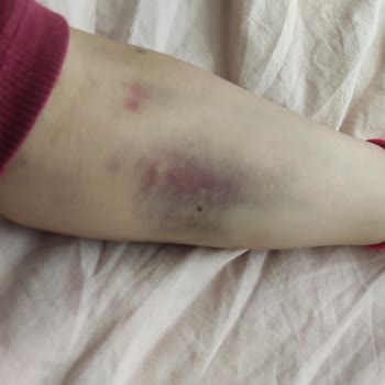 Bilkent Şehir Hastanesi Damar Yolu Açma Hatası Nedeniyle Kol Şişmesi Ve Hareket Kısıtlaması
