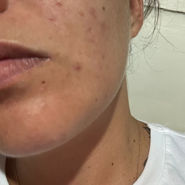 Avcılar Güzellik Merkezinde Leke Tedavisi Sonrası Yeni Lekeler Ve 30.000 TL Kayıp
