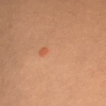 Velavit Probiotic Causes Severe Skin Reaction Requiring Medical Biopsy