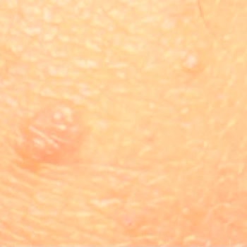 Velavit Probiotic Causes Severe Skin Reaction Requiring Medical Biopsy