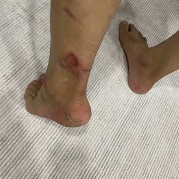 Enza Güzellik Salonu’nda Lazer Epilasyon Sırasında İkinci Derece Yanık Ve Geri Ödeme Reddi