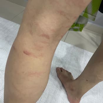 Enza Güzellik Salonu’nda Lazer Epilasyon Sırasında İkinci Derece Yanık Ve Geri Ödeme Reddi