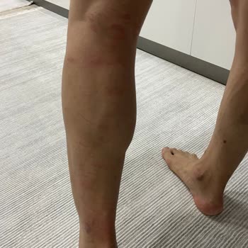 Enza Güzellik Salonu’nda Lazer Epilasyon Sırasında İkinci Derece Yanık Ve Geri Ödeme Reddi