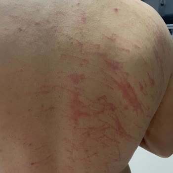 Enza Güzellik Salonu’nda Lazer Epilasyon Sırasında İkinci Derece Yanık Ve Geri Ödeme Reddi