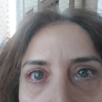 Chanel Rouge Noir Mascara Triggers Severe Allergic Reaction and Eye Redness
