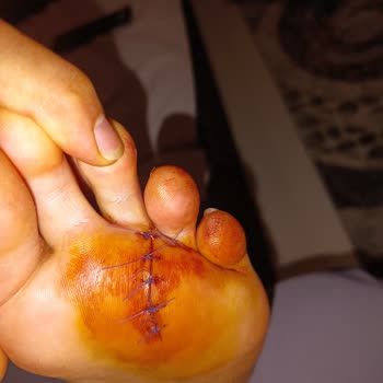 Deniz Kenarında Metal Çivinin Yol Açtığı Yaralanma Ve Yardım İhmali