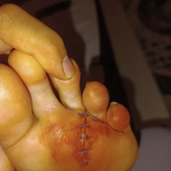 Deniz Kenarında Metal Çivinin Yol Açtığı Yaralanma Ve Yardım İhmali