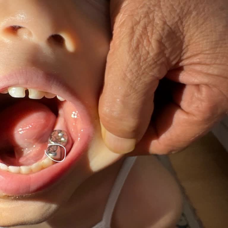 Delinen Krom Kaplaması Nedeniyle Çocuğumun Sürekli Ağrısı Ve Doktorun Görmezden Gelmesi