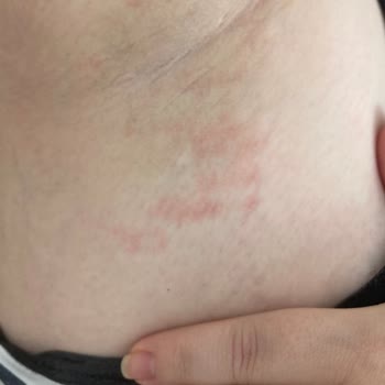 Bee Beauty Glikolik Tonik’te Yanık, Gratis Müşteri Hizmetleri Yanıt Vermiyor
