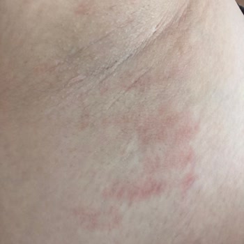 Bee Beauty Glikolik Tonik’te Yanık, Gratis Müşteri Hizmetleri Yanıt Vermiyor