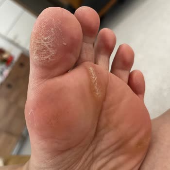 Skechers Beyaz Model Ayakkabının Sert Tabanı Nedeniyle Şiddetli Ayak Ağrısı Ve İade Talebi