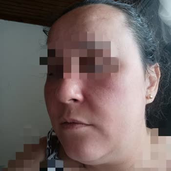Celenes Vitamin C Ürünü Yüzde Şiddetli Yanma Ve Şişme