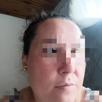 Celenes Vitamin C Ürünü Yüzde Şiddetli Yanma Ve Şişme