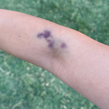 Medipol Bahçelievler Acil Serviste Tecrübesiz Hemşireler Ve Ağrılı Kanama