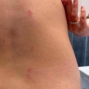 Elisa World Üsküdar Şubesinde Yanıkla Sonuçlanan Lazer Epilasyon Şikayeti