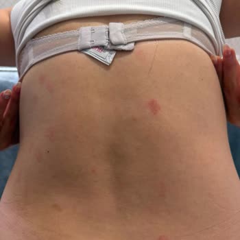Elisa World Üsküdar Şubesinde Yanıkla Sonuçlanan Lazer Epilasyon Şikayeti