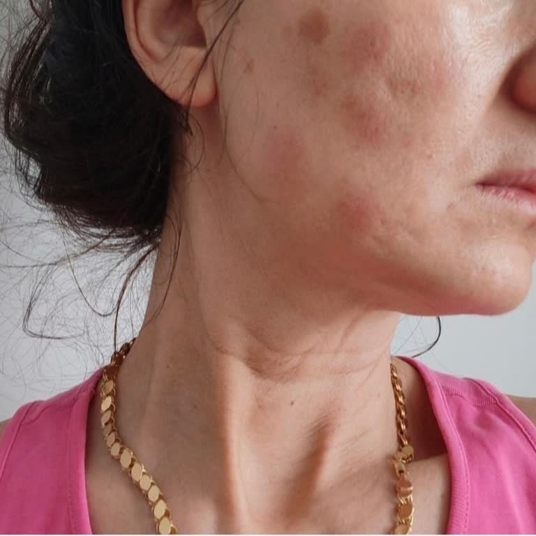 Çorlu Güzellik Salonunda Botoks Ve Somon DNA Sonrası Sağlık Sorunları Ve 21.000 TL İadesi