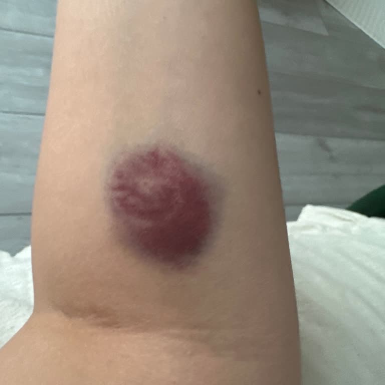 Kan Alımında Damar Patlaması Ve Yetersiz Bilgilendirme