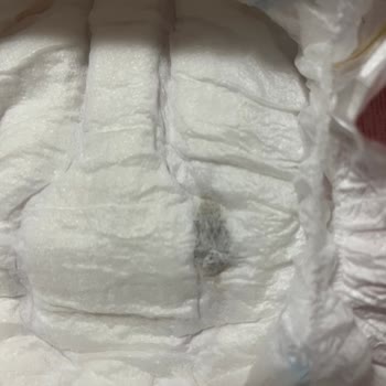 Bebek Bezinde Yabancı Cisim Bulunması Üzerine Şikayet Ve Açıklama Talebi