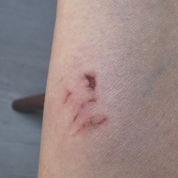 Cinatı Köpek Isırmasına Maruz Kaldım